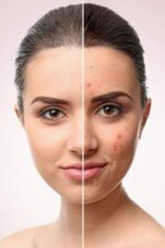 Mistine Acne Face Cream - Image 2